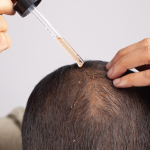 Hair Loss Prevention: Try Topical Finasteride Today