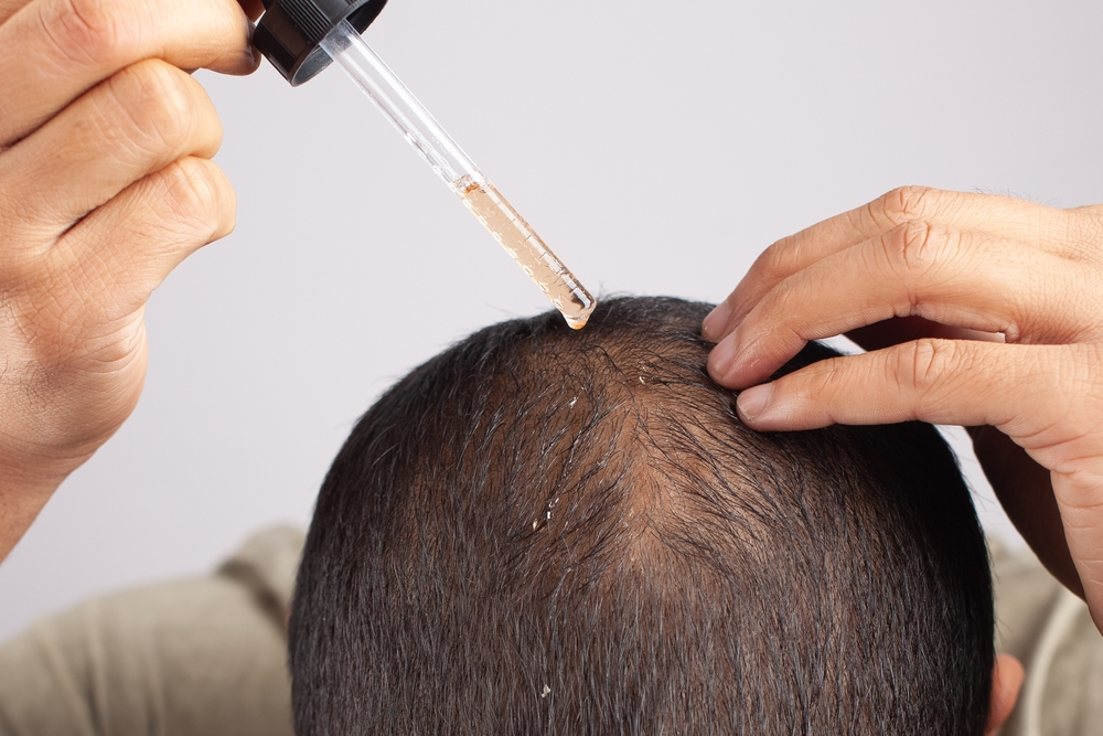 Hair Loss Prevention: Try Topical Finasteride Today